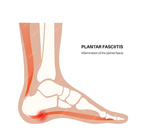 plantar fascia impact testing|plantar fasciitis foot anatomy.